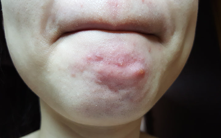 cystic chin acne