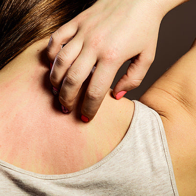 How To Treat Skin Rashes With Ayurvedic Solutions?