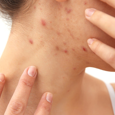 How To Treat Red Spots On Skin With Ayurvedic Remedies?