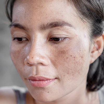How To Get Rid Of Skin Discoloration with Ayurvedic Treatments?