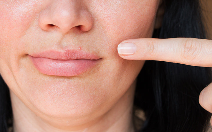 Cold Sore vs Pimple: How to Prevent, Treat, and Tell the