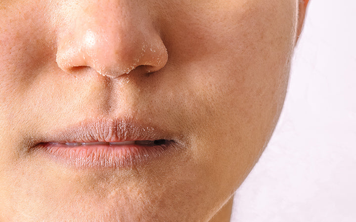 Dry Skin Around The Nose: Causes, Treatment, & Prevention – Vedix