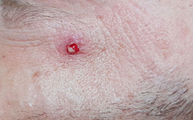 pimple like sores on body