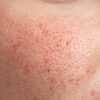 How To Get Rid Of Open Pores On Your Face?