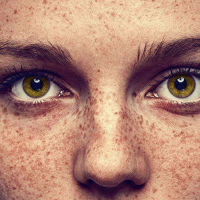 How To Lighten Your Freckles With Ayurvedic Remedies?
