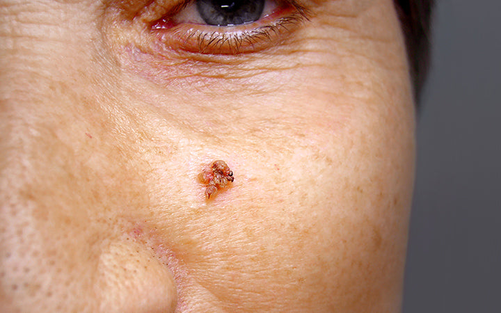 wart removal on face