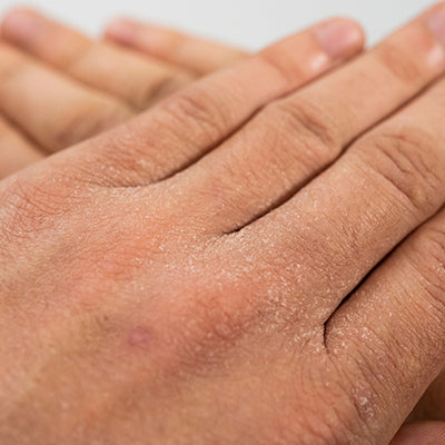 Exfoliative Dermatitis: Causes, Symptoms, Diagnosis, & Treatment