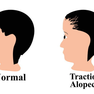 How To Prevent Traction Alopecia Before It’s Too Late?