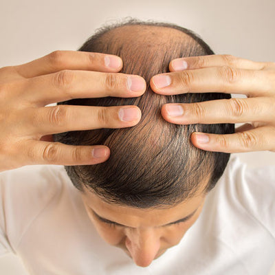Hair Loss: 7 Types And Ayurvedic Ways To Cure It