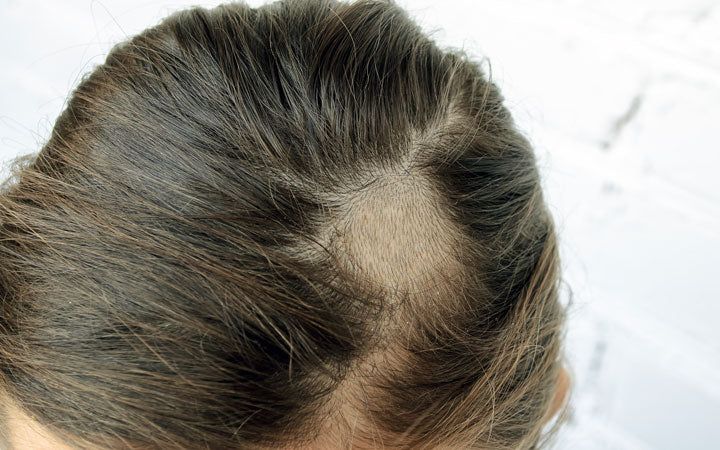 Ringworm of The Scalp (Tinea Capitis) - Causes, Symptoms And Remedies
