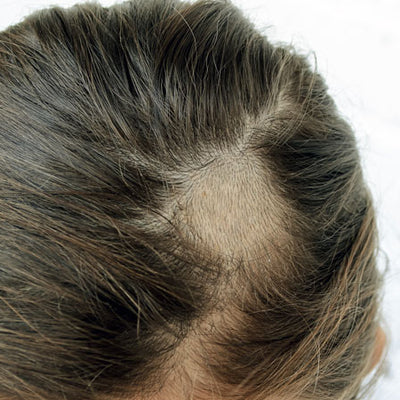 Tinea Capitis - How Can Ayurveda Treat Your Scalp Condition?