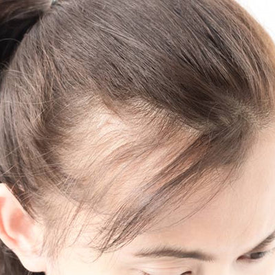 Ayurvedic Ways To Treat Female Pattern Baldness