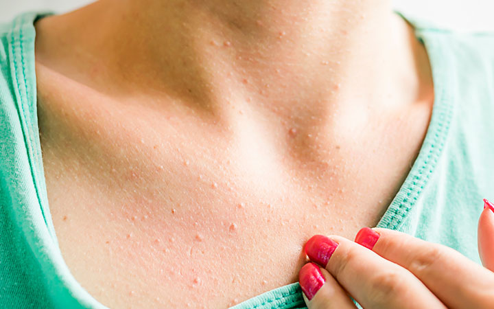 Chest Acne: Why You Have It & How To Treat It Holistically? – Vedix