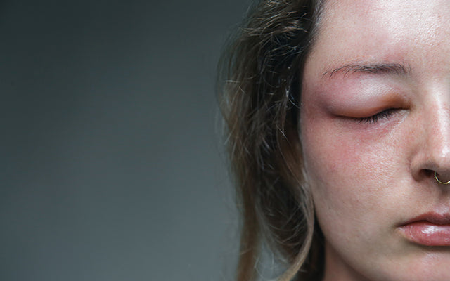 An Ayurvedic Guide To Cure Face Swelling