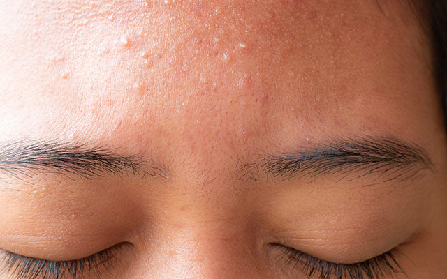 Can Acne Occur On Dry Skin Know Its Causes Treatments And Useful Tips