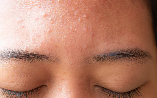 Can Acne Occur On Dry Skin? Know Its Causes, Treatments & Useful Tips