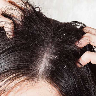Can Dandruff Cause Hair Loss? How To Treat It?
