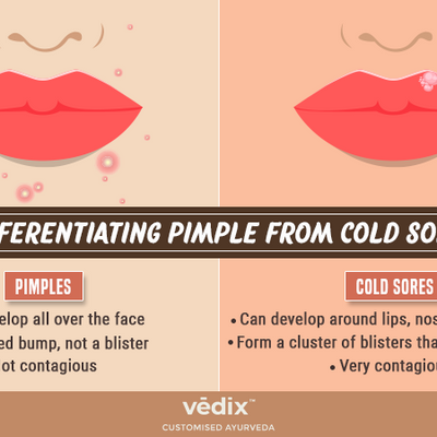 How To Identify Whether You Have A Pimple Or A Cold Sore?