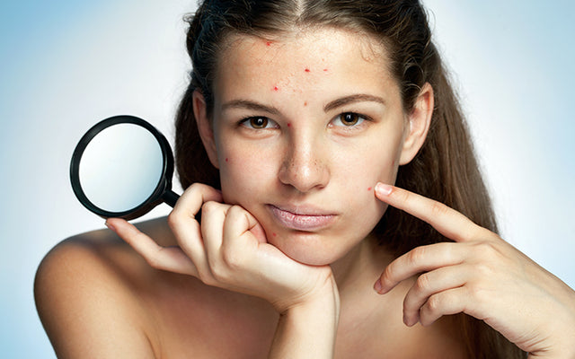 How To Deal With Skin Purging Using Ayurvedic Remedies?