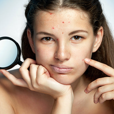 How To Deal With Skin Purging Using Ayurvedic Remedies?