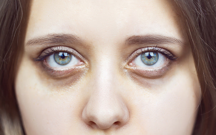 Dark Circles Under Eyes: Causes, Treatments & Preventive Tips