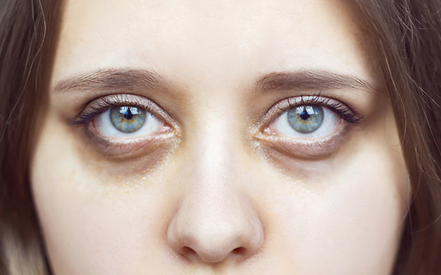 Causes and solutions for puffy eyes - The Skin and Wellbeing