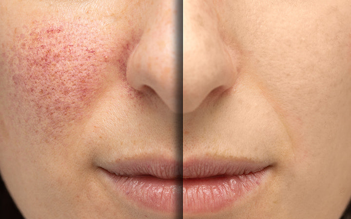 10 Natural Remedies To Treat Rosacea