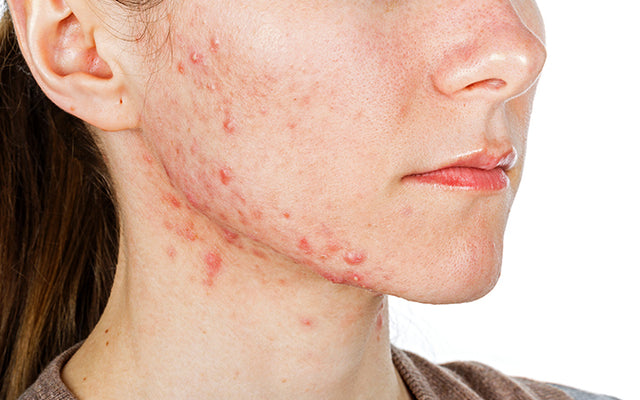 How To Quickly Treat Your Cystic Acne With Ayurvedic Secrets?