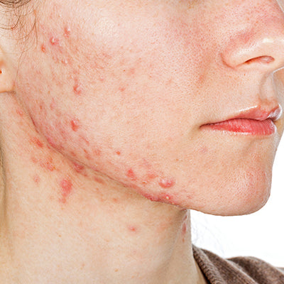 How To Quickly Treat Your Cystic Acne With Ayurvedic Secrets?