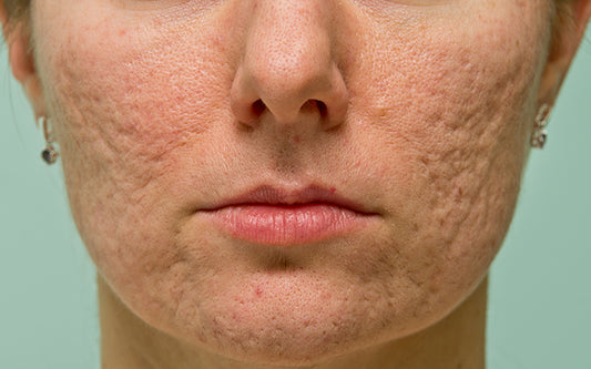 How To Treat Acne Scars With Ancient Ayurvedic Secrets?