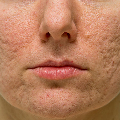 How To Treat Acne Scars With Ancient Ayurvedic Secrets?