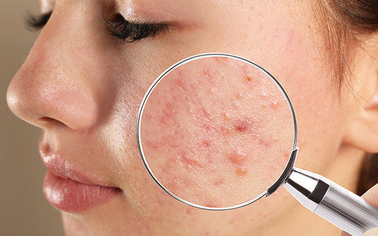 How To Treat Your Blind Pimples With Ayurveda?
