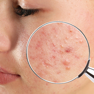 How To Treat Your Blind Pimples With Ayurveda?