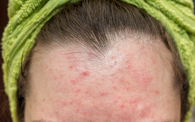How To Treat Fungal Acne With Ayurvedic Solutions?