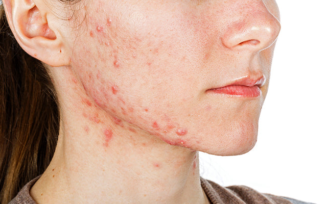 How To Fight Hormonal Acne Breakouts With Ayurvedic Remedies?