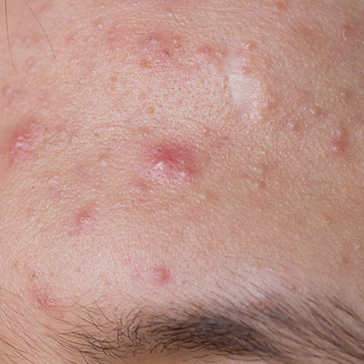 How To Get Rid Of Acne On Forehead Naturally?