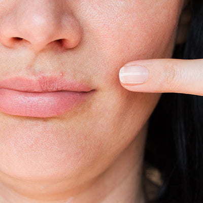 How To Get Rid Of Pimples On Your Lips With Ayurvedic Remedies?