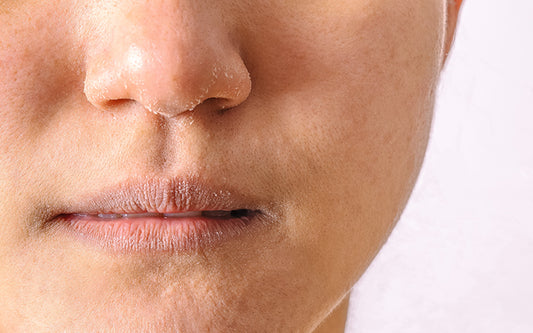 Dry Skin Around The Nose: Causes, Treatment, & Prevention