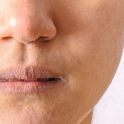 Dry Skin Around The Nose: Causes, Treatment, & Prevention