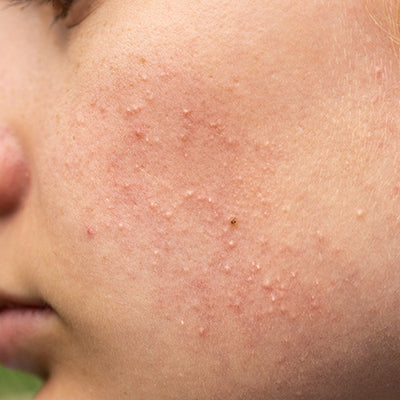 How To Resolve Your Comedonal Acne Problems With Ayurveda?