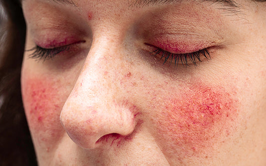 Redness On Face: Causes, Symptoms, Treatments & Prevention