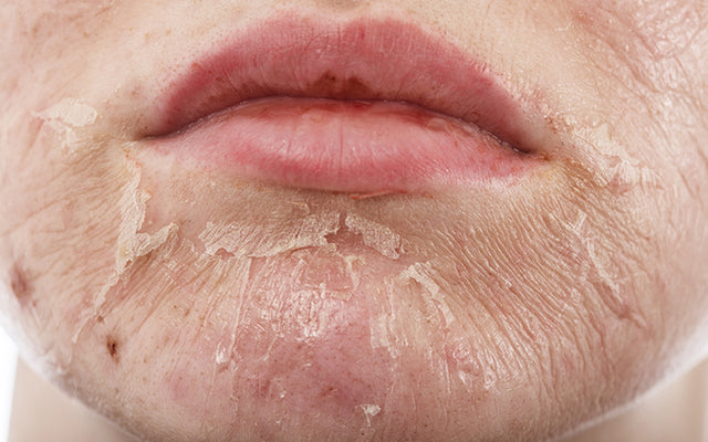 How To Treat Skin Peeling On The Face With Ayurveda?