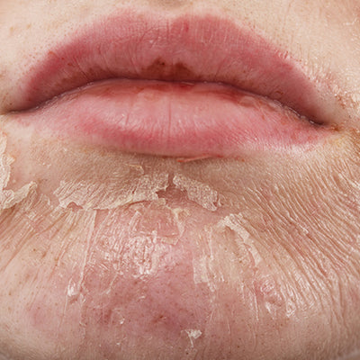 How To Treat Skin Peeling On The Face With Ayurveda?