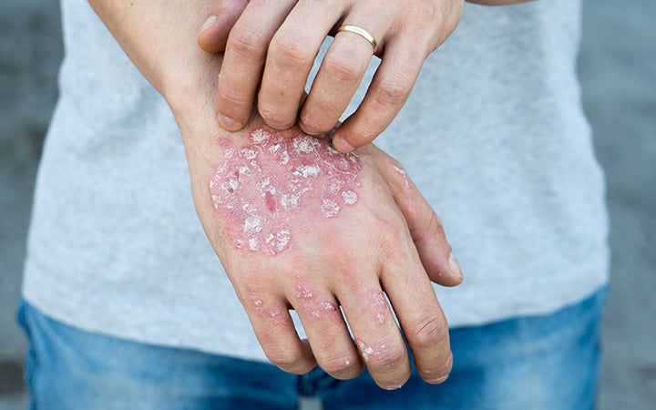 How To Prevent Psoriasis With Natural Ayurvedic Remedies?