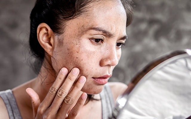 How To Reduce Hyperpigmentation With Ayurvedic Treatments?