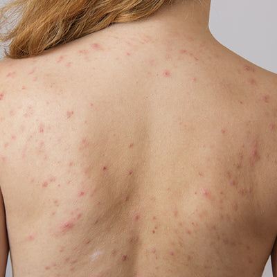 How To Treat Back Acne With Ayurvedic Solutions?