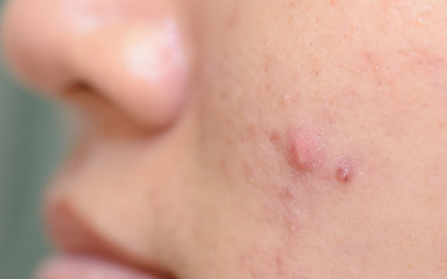 How To Treat Acne Papules With Ayurvedic Remedies?