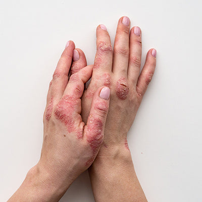 How To Manage Your Psoriasis Symptoms With A Balanced Diet?