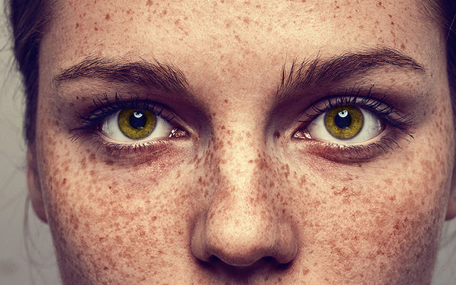 How To Lighten Your Freckles With Ayurvedic Remedies?