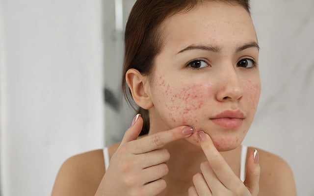 Types Of Acne, Their Causes, Ayurvedic Remedies & Diet To Follow